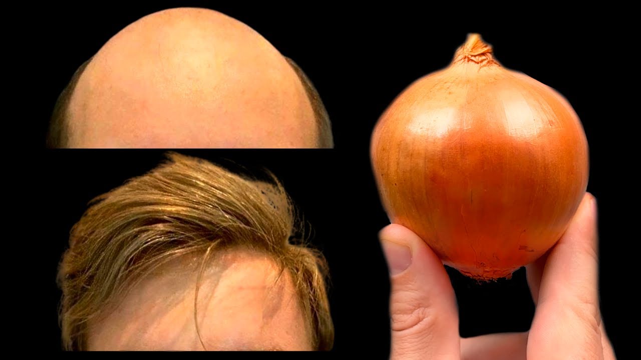 Discover the Magic of Onions: A Natural Boost for Your Hair