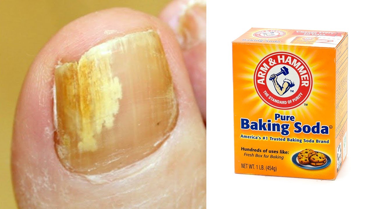 Eradicate Toenail Fungus Naturally with Baking Soda: A 100% Natural Treatment