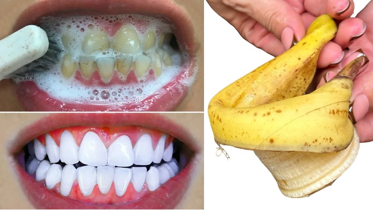 Brighten Your Smile with Banana Peel: Quick Teeth Whitening Magic