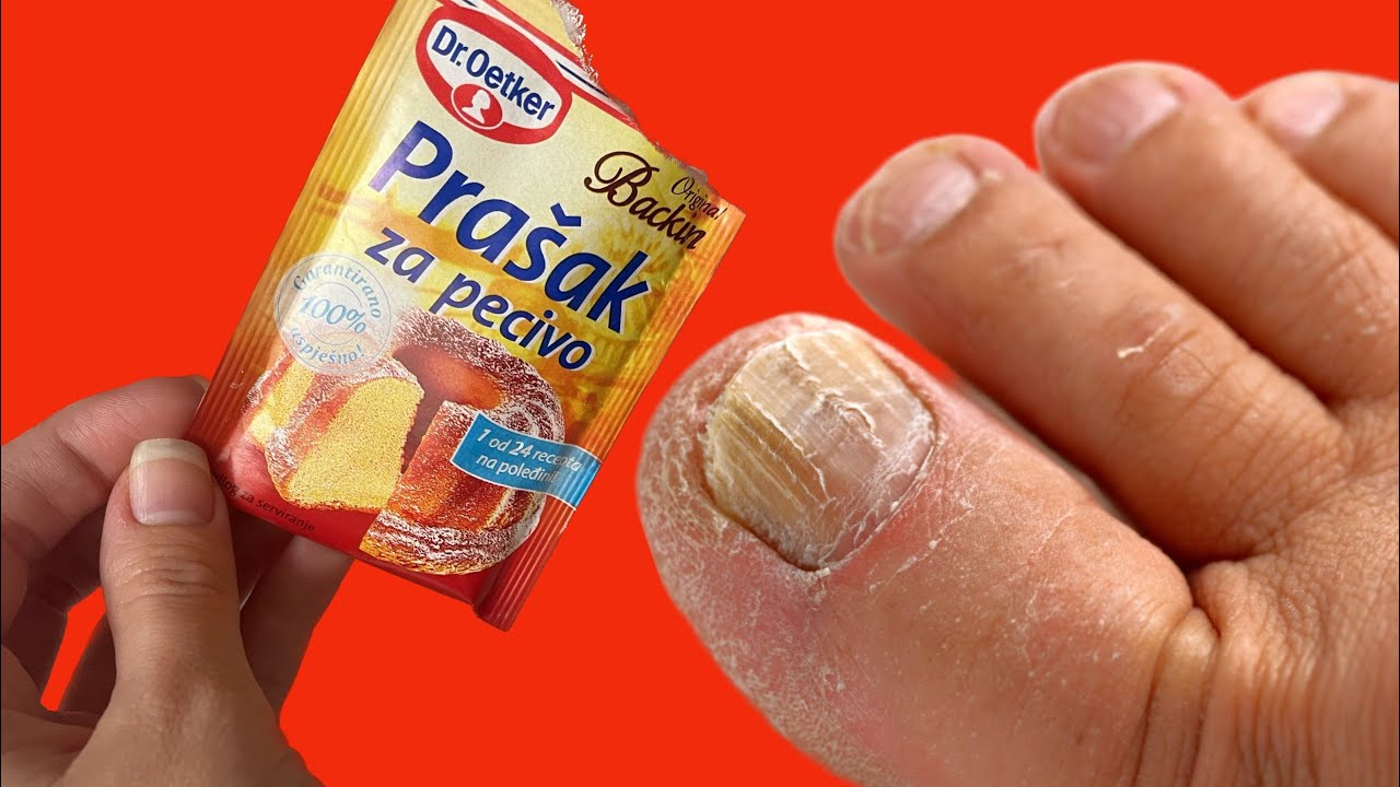 Nail Fungus No More: A 100% Natural Baking Soda Remedy for Toenail Fungus