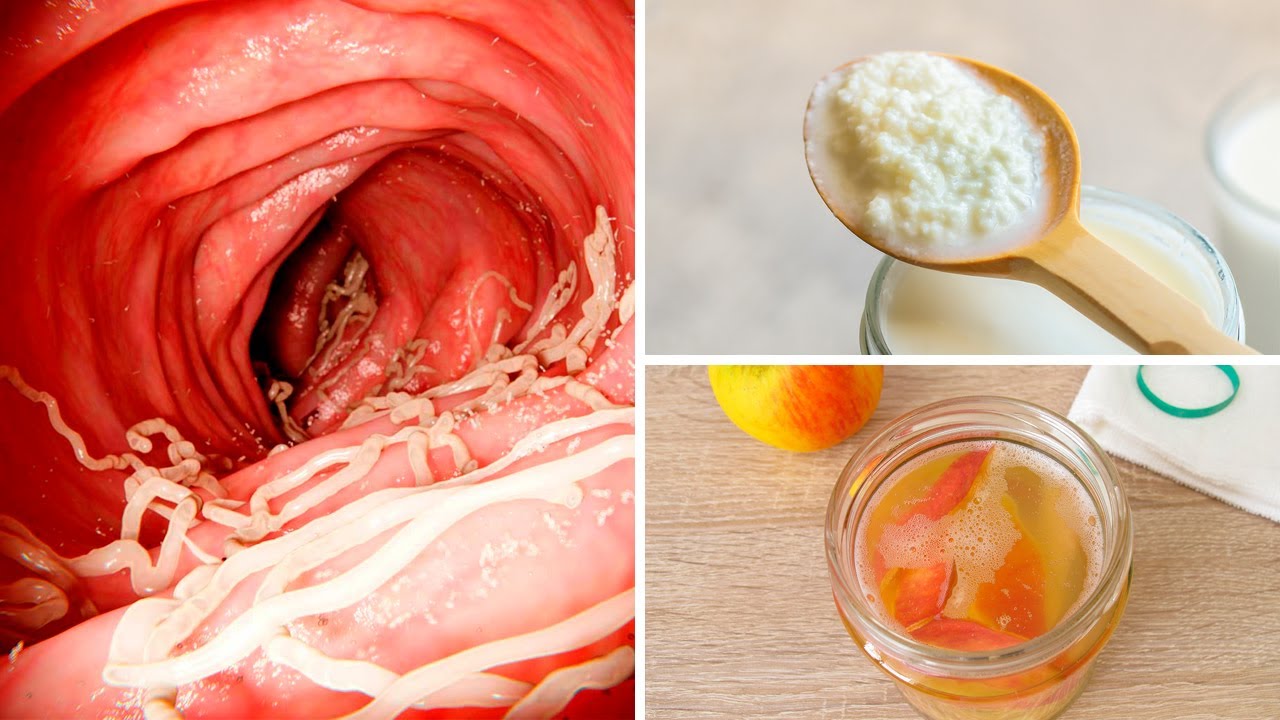 Winning the Battle Against Intestinal Worms: 5 Natural Foods to the Rescue