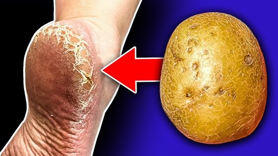 Smooth and Soothe: The Magic Potato Remedy for Cracked Heels