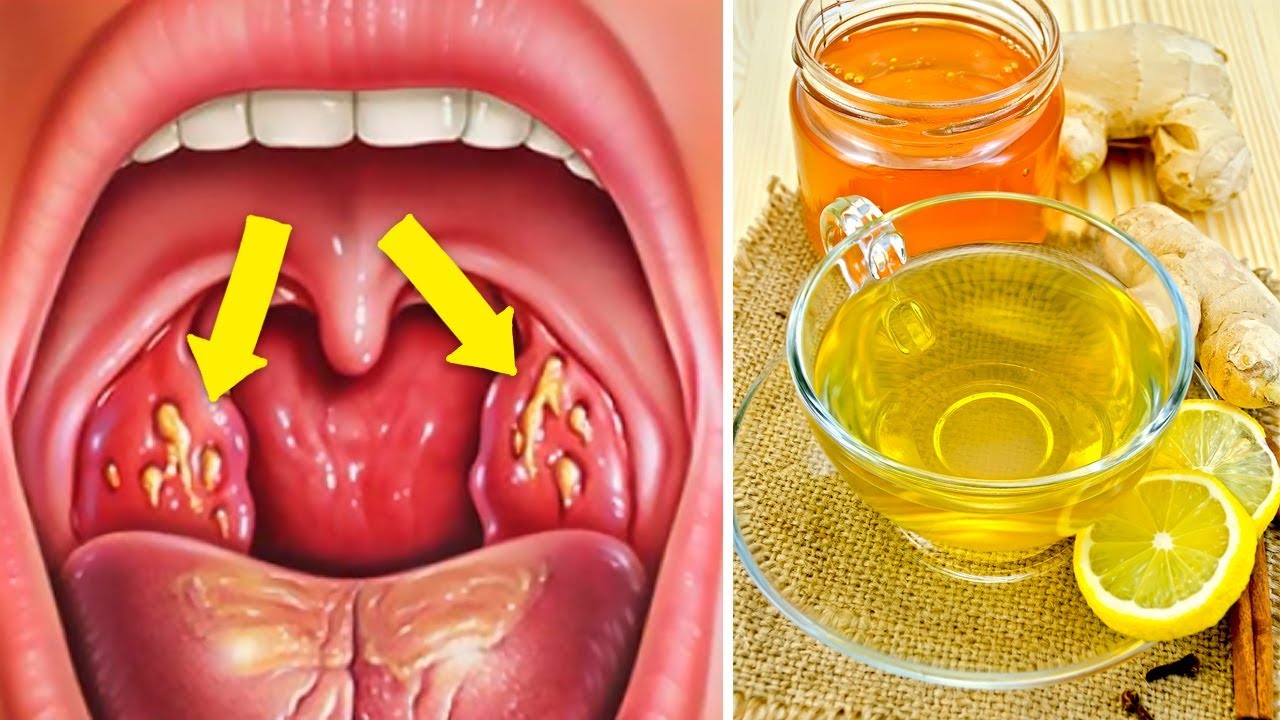 Soothing Tonsillitis Naturally: A Herbal Honey Remedy