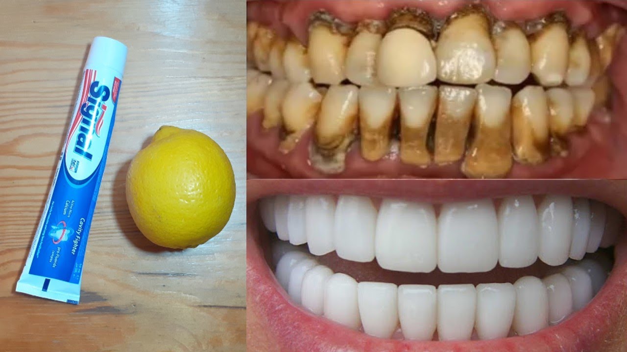 Brighten Your Smile Naturally: Lemon and Toothpaste for Teeth Whitening