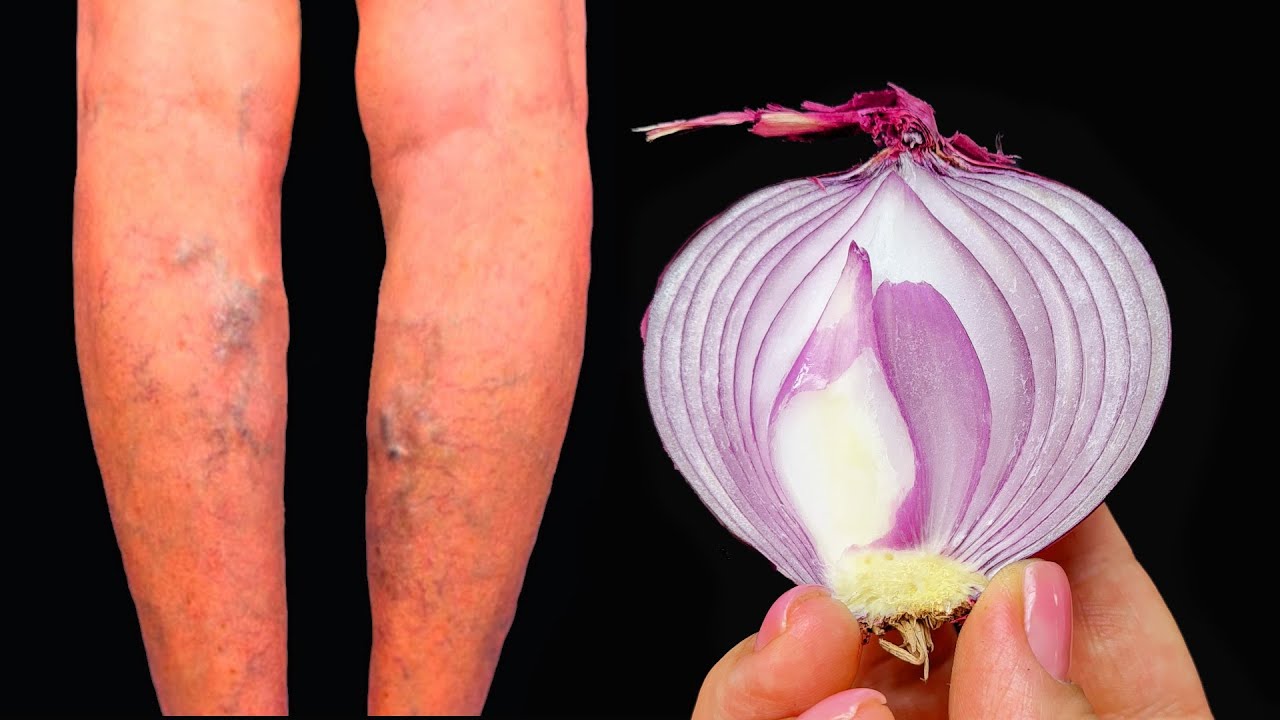 Say Goodbye to Varicose Veins: Two Remarkable Home Remedies