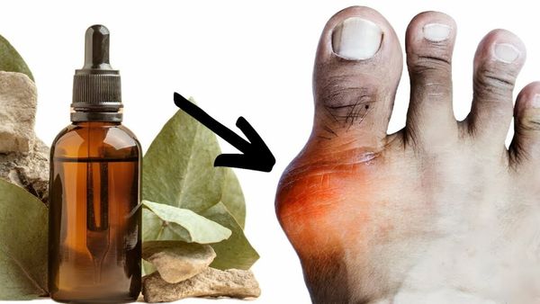 Finding Relief from Gout: The Power of Essential Oils